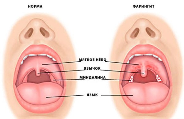 Воспаление ротовой полости