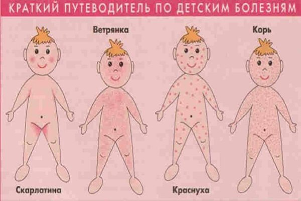 Хронический гранулезный фарингит