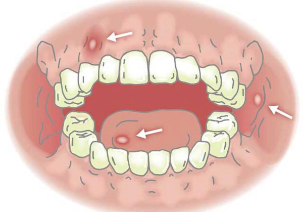 Ветряная оспа высыпания сыпь