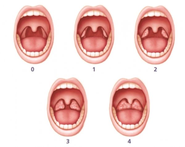 Герпесный стоматит язвы