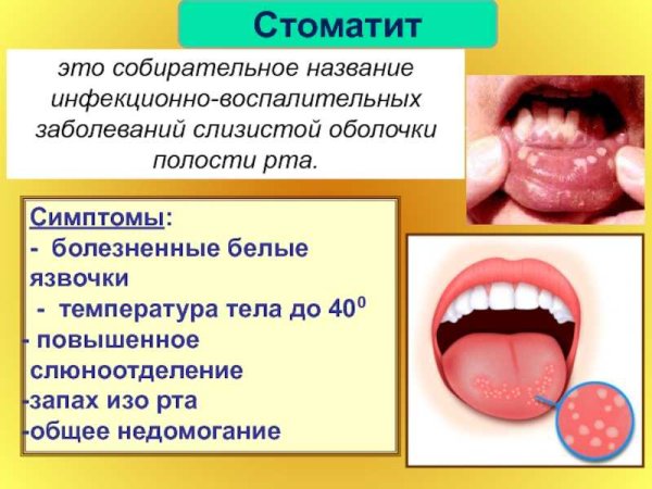 Герпигерписная анангина