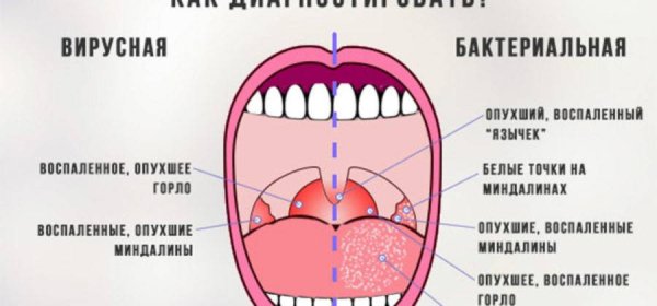Гнойная ангина антибиотики вирусная