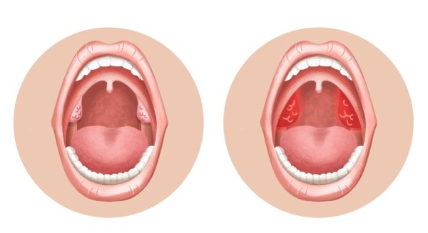 Анатомия твердого неба верхней челюсти