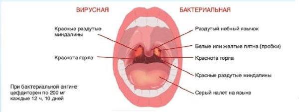 Эрозивно язвенный стоматит