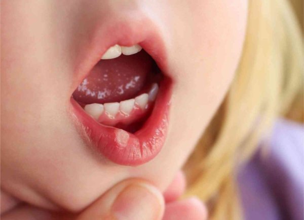 Ангина налет на миндалинах