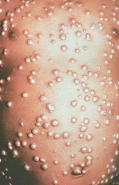 Воспалились бугорки на корне языка