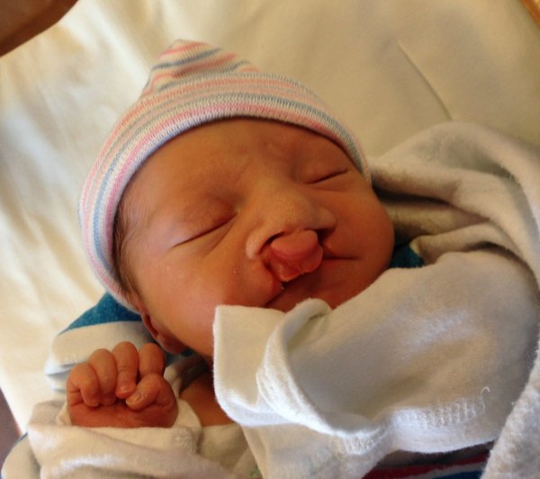 Хейлосхизис (заячья губа)