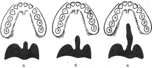 Невидимые (лингвальные) брекеты