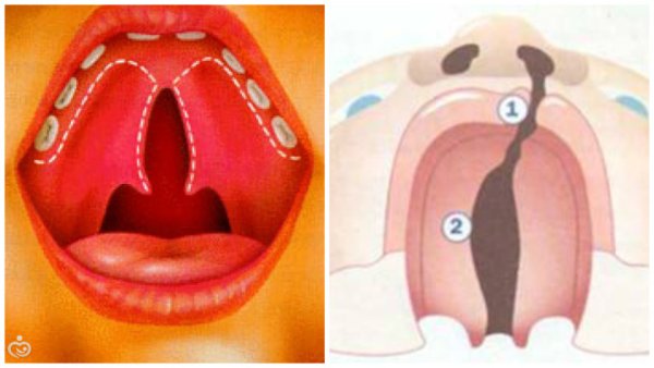 Волчья пасть расщелина твердого неба