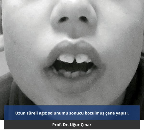 Твердое небо резцевой сосоцек