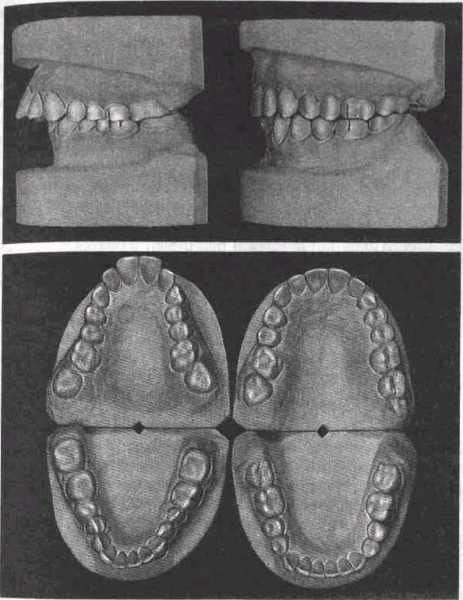 Ринолалия Волчья пасть