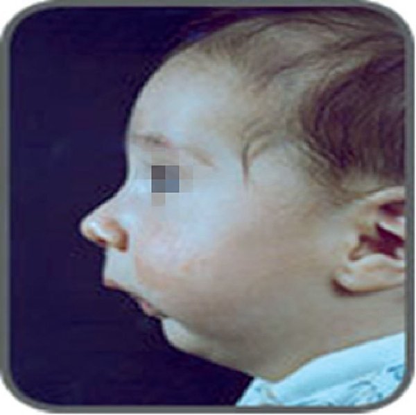 Волчья пасть расщепление неба