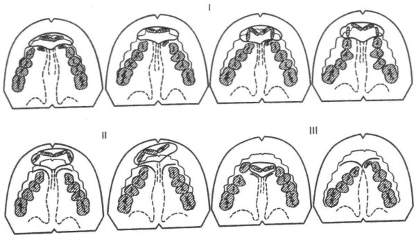 Боковой открытый прикус исправление