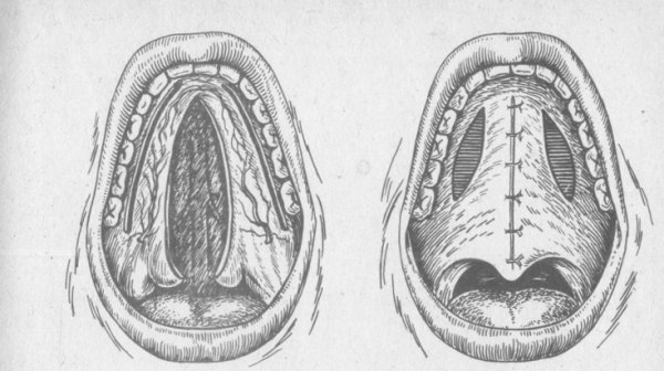 Гнойная фолликулярная ангина