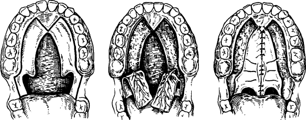 Врожденная расщелина мягкого неба