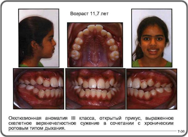 Врожденные дефекты твердого неба классификация