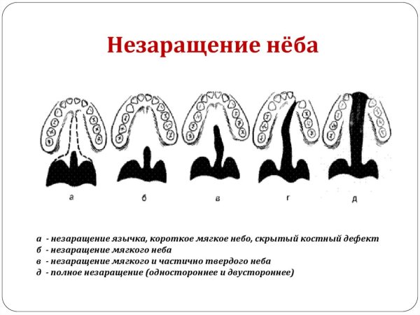 Формы ската мягкого неба