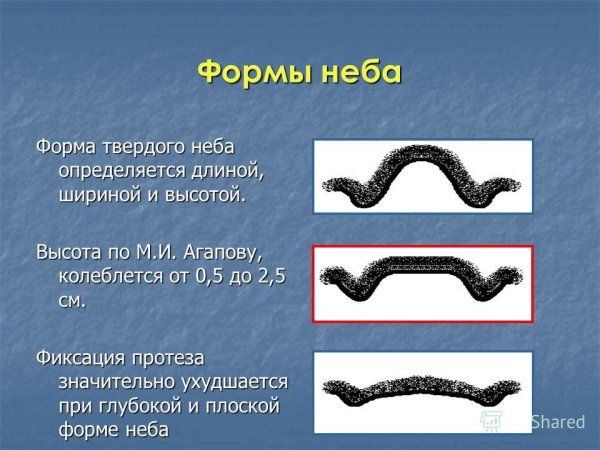 Незаращение верхнего нёба («Волчья пасть»),