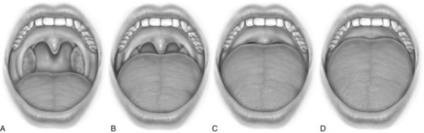 Гипертрофия миндалин 2 степени