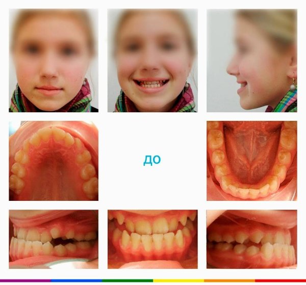 Гипердонтия (сверхкомплектные зубы