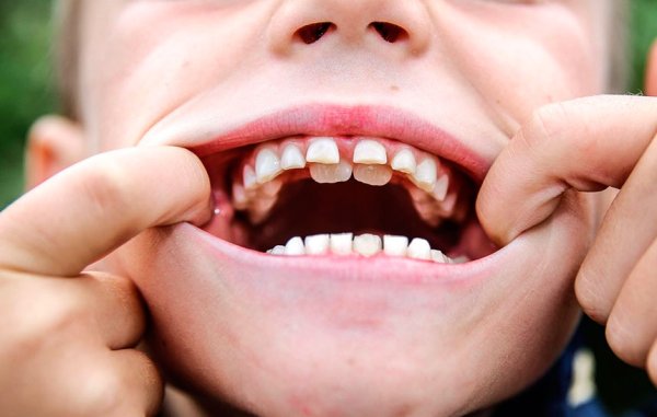 Зубной ряд верхней челюсти