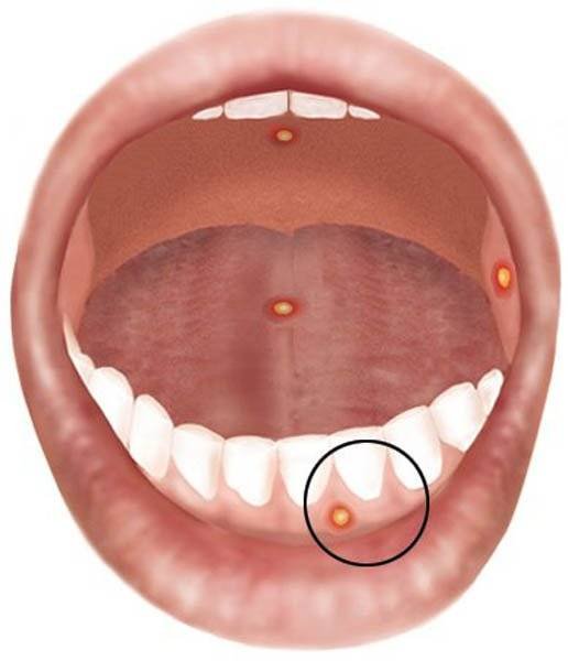 Кандидозный стоматит стоматит