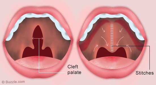Врожденная расщелина неба классификация