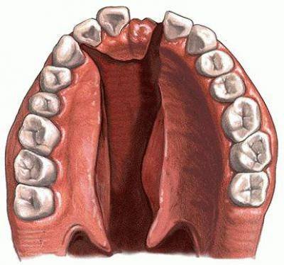 Незаращение твердого неба причины