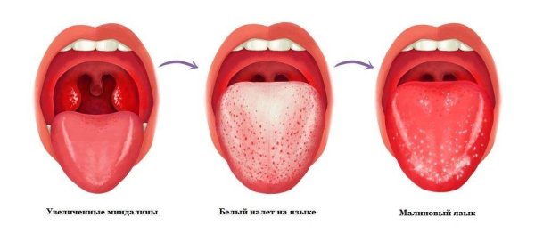 Воспаление полости рта