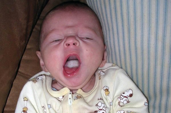 Клинические проявления тонзиллита