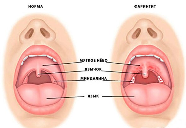 Дифтерия ротоглотки островчатая