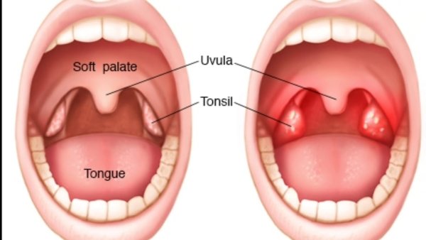Глоточная (аденоидная) миндалина