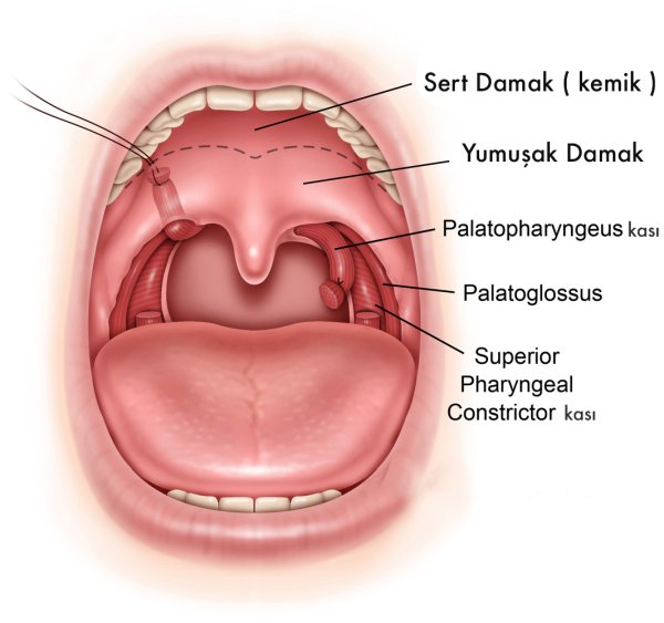 Ангина небных миндалин