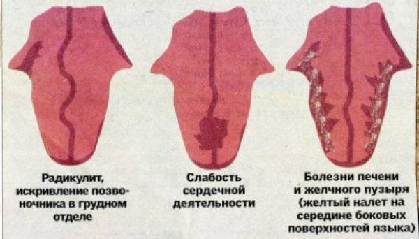 Эксфолиативный глоссит