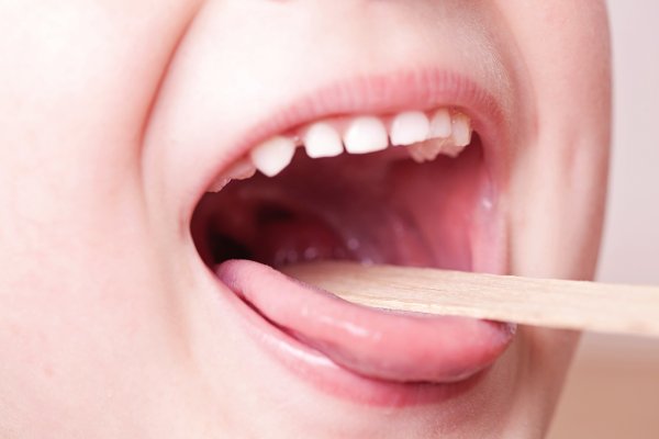 Глоссит Гюнтера Миллера