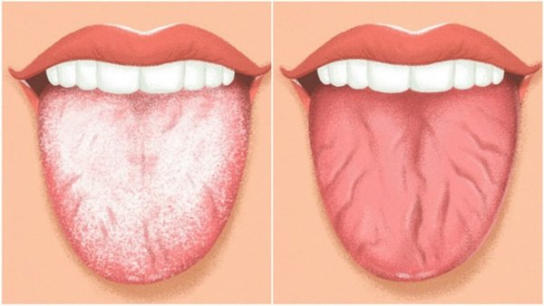 Герпетический афтозный стоматит