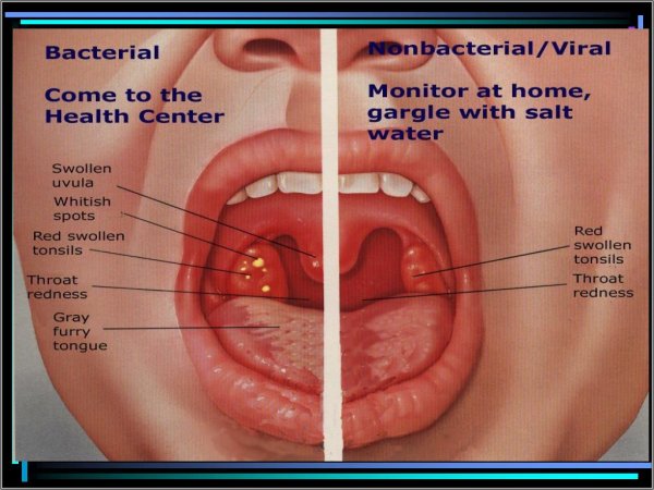 Гипертрофия миндалин 2 степени