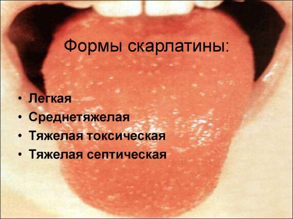 Красные пятна на языке у ребенка