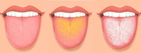 Скарлатина стрептококк