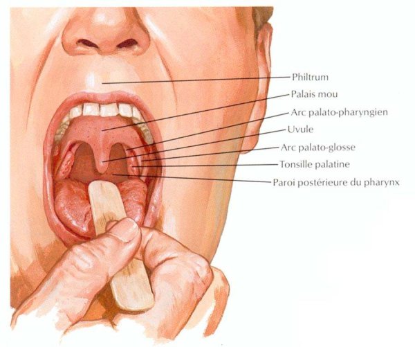 Ангина небных миндалин