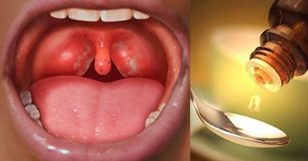 Воспаление полости рта