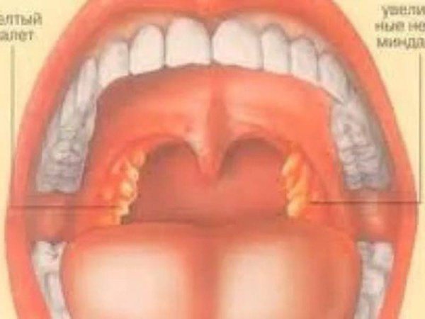 Воспаление слизистой оболочки ротовой полости