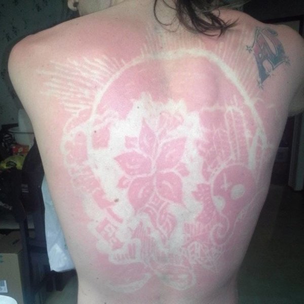 Степени химических ожогов глаза