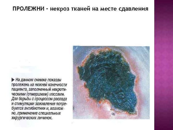 Себорееподобный дерматит