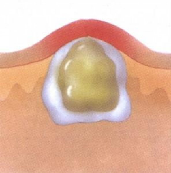 Фигуры Лихтенберга от молнии