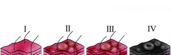 Ожог слизистой нашатырным спиртом