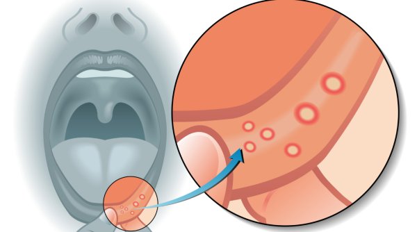 Полоскание горла при ангине