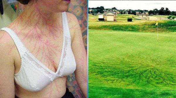 Термический ожог роговицы