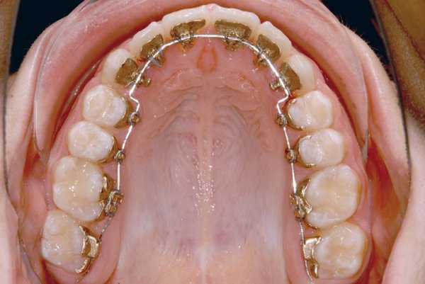Лингвальная брекет система
