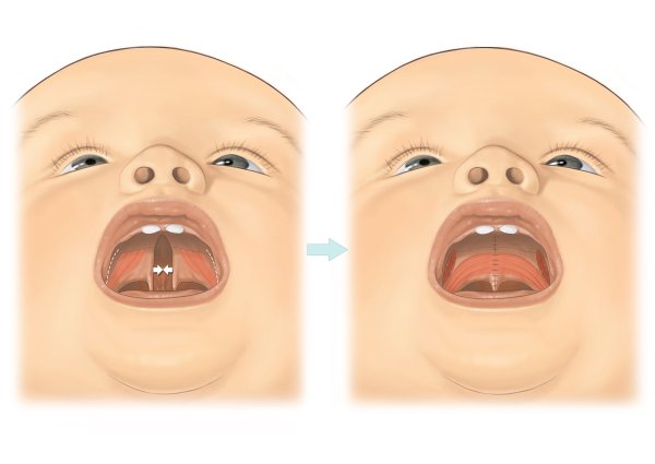 Заячья губа и Волчья пасть